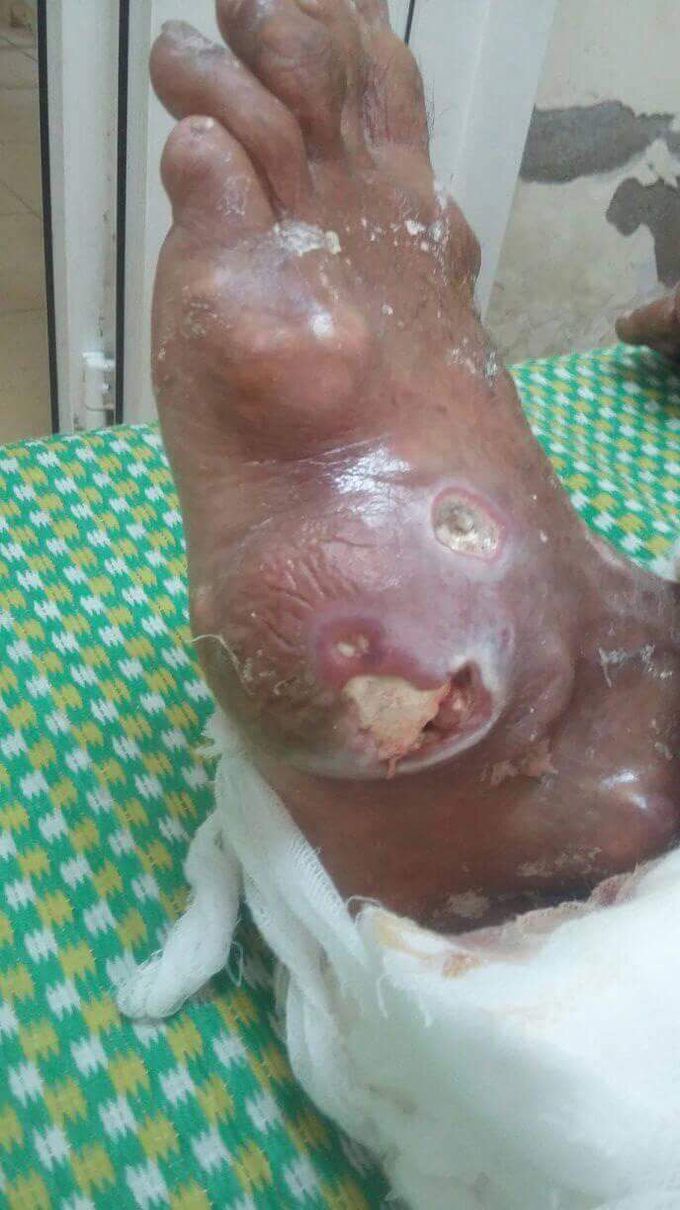 Complication of gout