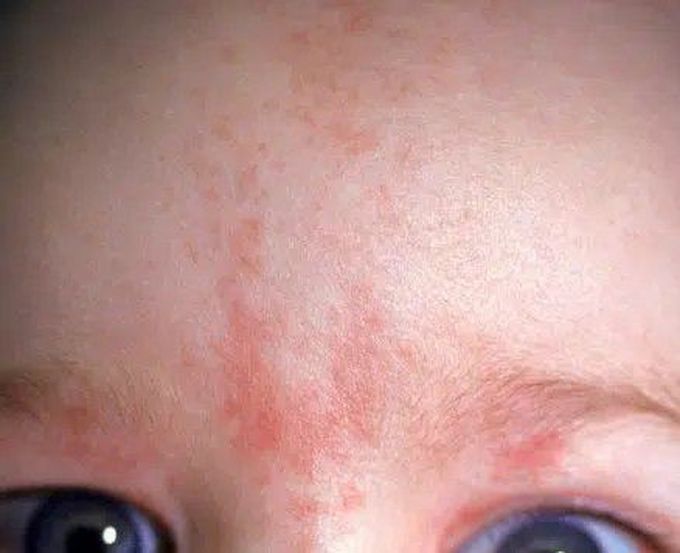 Cause of salmon patch MEDizzy