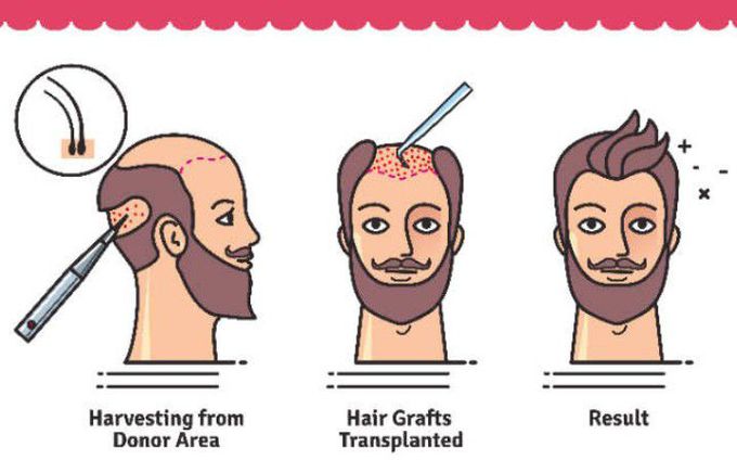 hair transplant