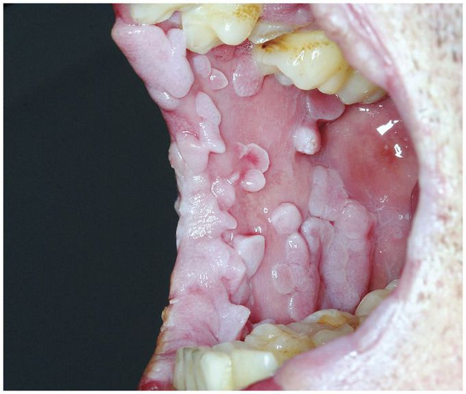 Oral HPV-Associated Papillomatosis in AIDS