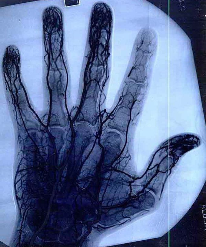 Hand angiogram