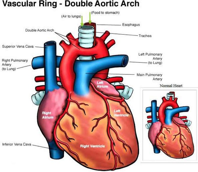 Arch of aorta... or arches??