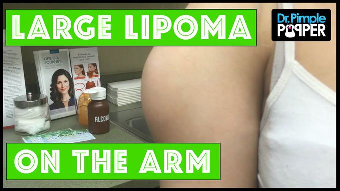 Large lipoma on the arm