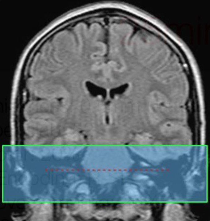 Slice prescription boundaries and orientation for axial imaging of the IAC