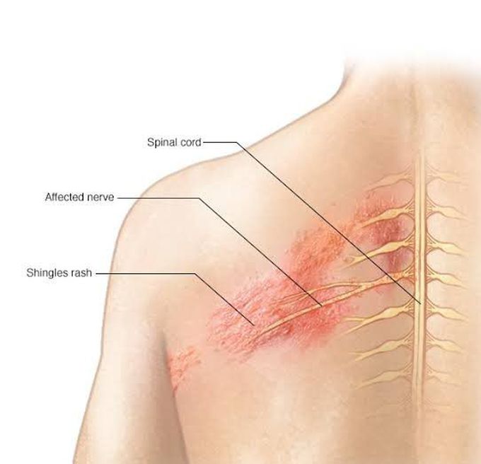 Symptoms of postherpetic neuralgia