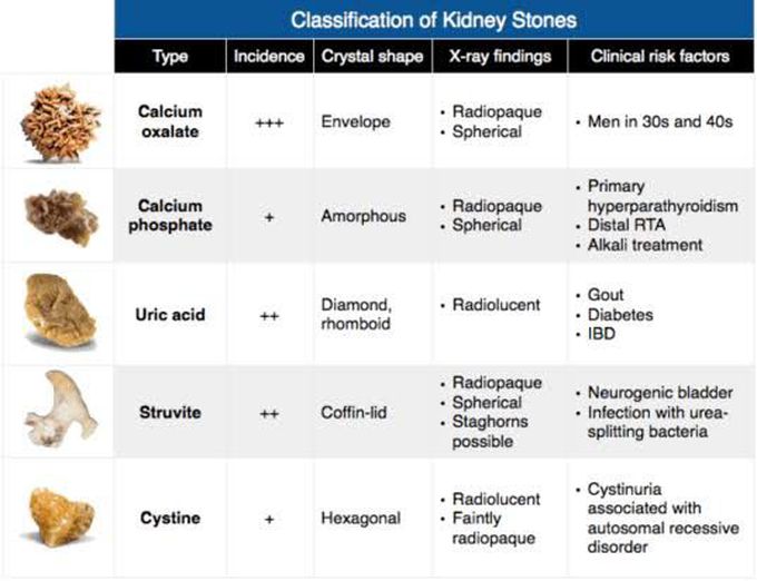 Classification of kidney stones
