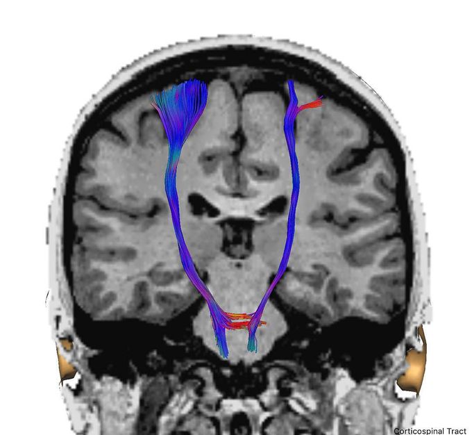 Corticospinal tract!