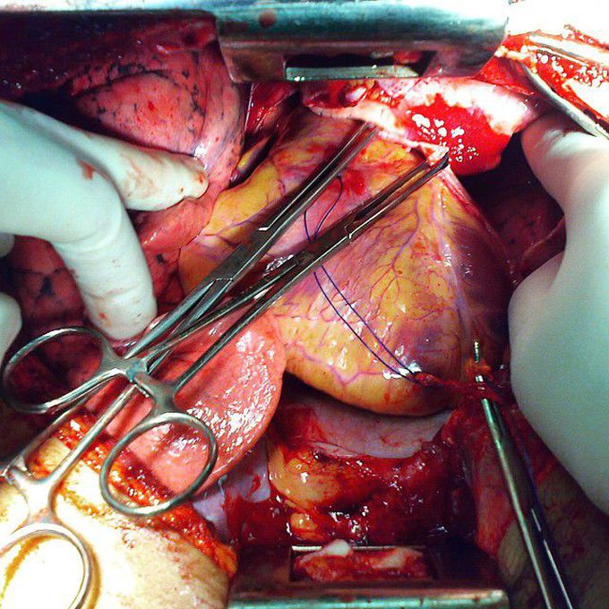 Biventricular shotgun injury of the heart