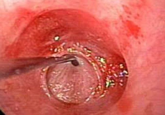 Plummer vinsons syndrome