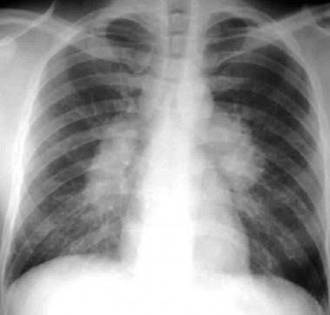 DDx? For this x-ray and most common cause