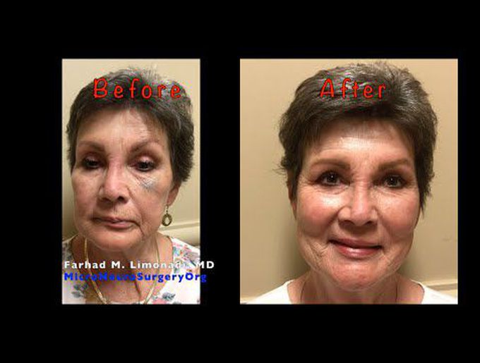 Hemifacial spasm and surgical management. Microvascular decompression of facial nerve (MVD).Outcome!