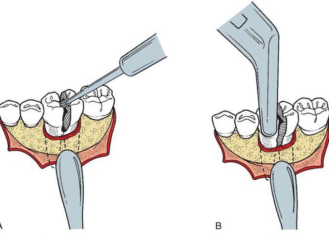 Open extraction of multi rooted tooth