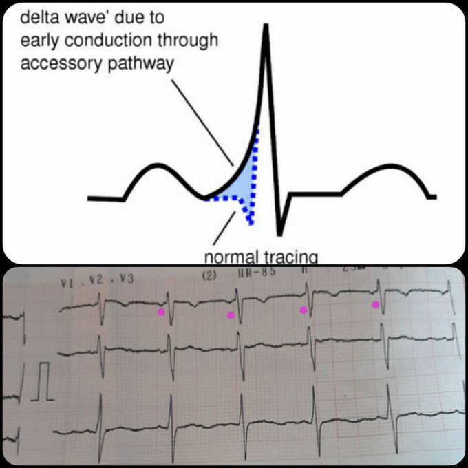 Delta wave