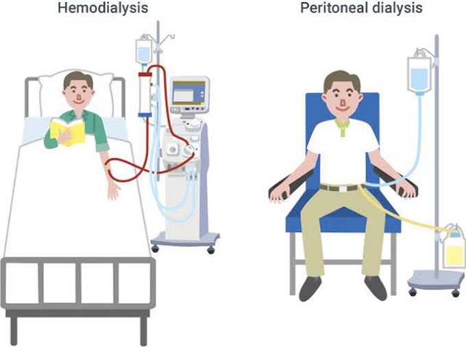 Types of dialysis
