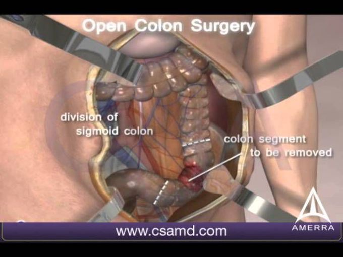 Open Colorectal Surgery 3D Animation - Open Procedure