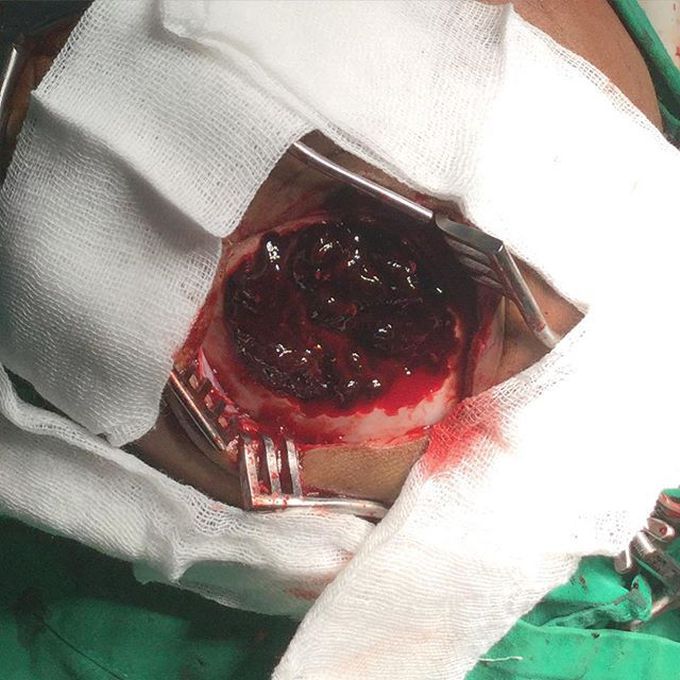 Epidural hematoma
