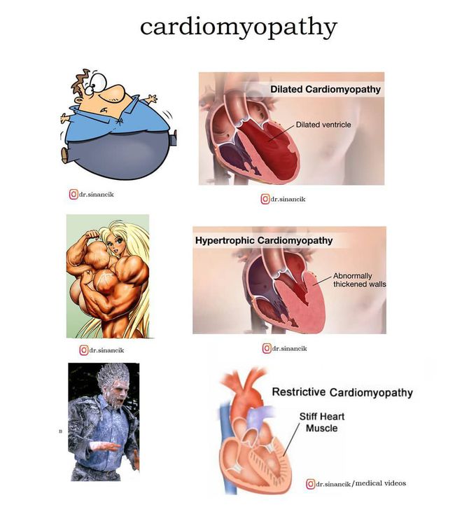 Differential types of cadiomyopathyes ins dr.sinancik