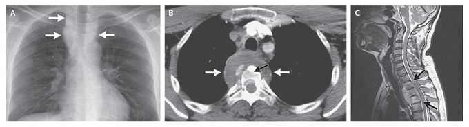 Pott's Disease of the Thoracic Spine