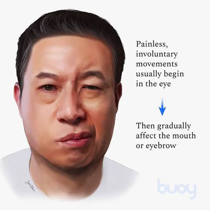Hemifacial Spasm MEDizzy