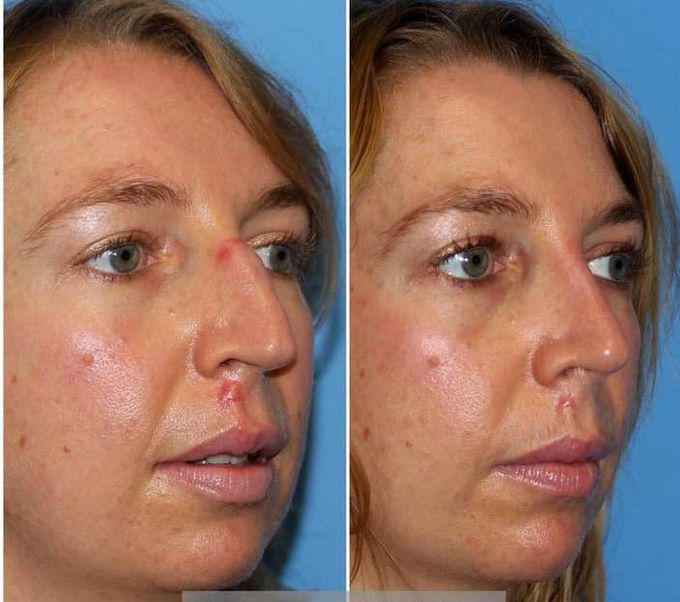 Post-Traumatic Rhinoplasty