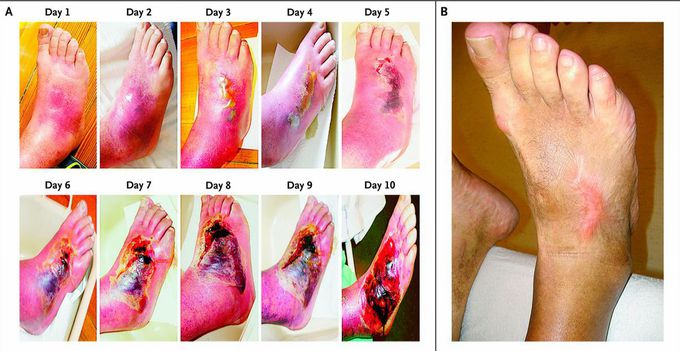 Evolution of a Diabetic Foot Infection