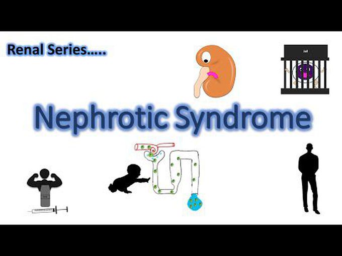 Animated explanation of pathophysiology of Nephrotic syndrome