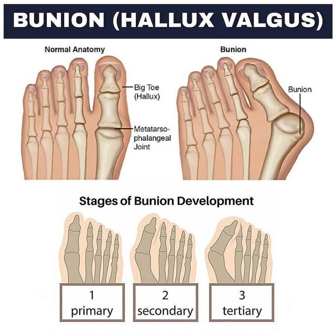 Bunions