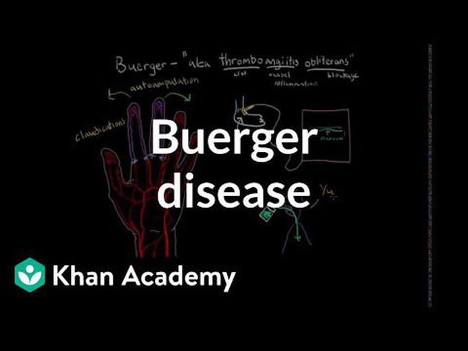 What is Buergers disease