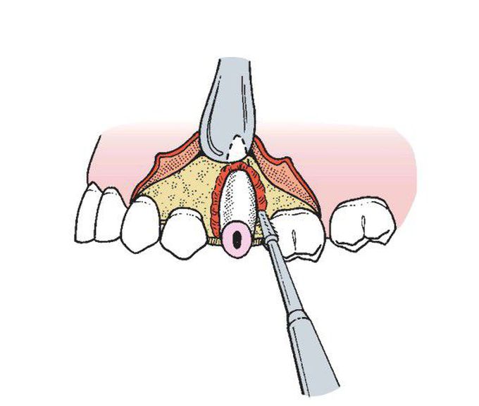 Extraction of root