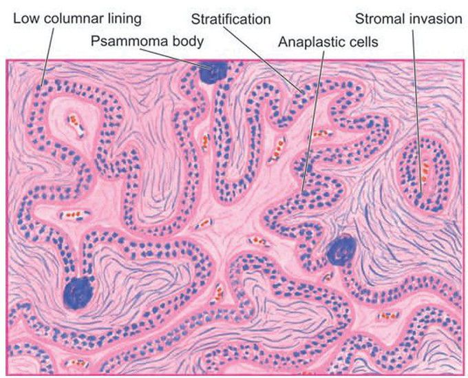 Papillary serous cystadenocarcinoma of the ovary.