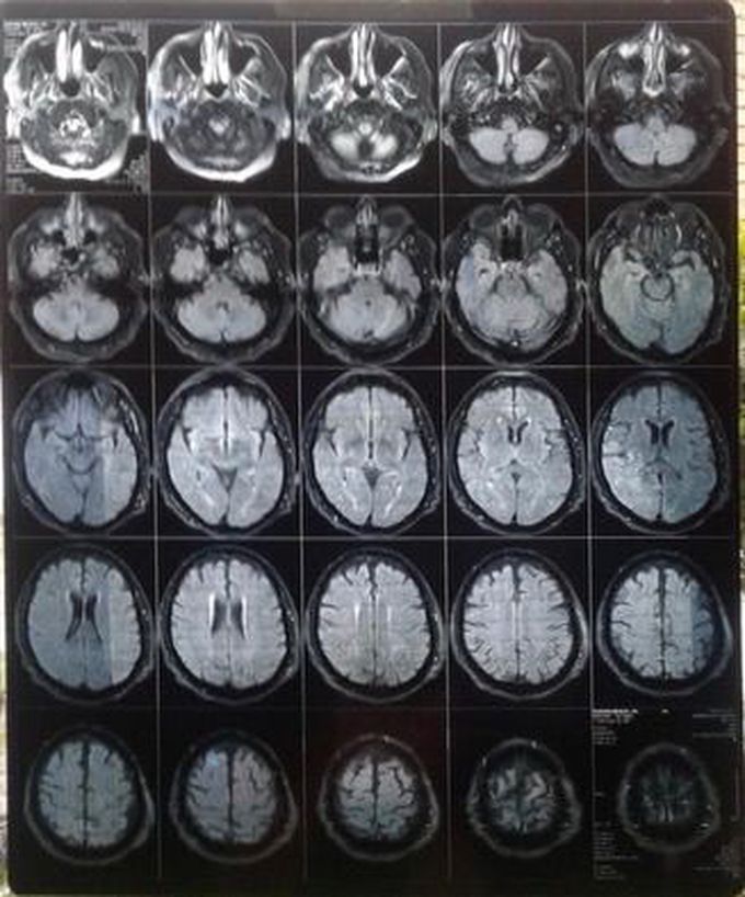Neuroimaging