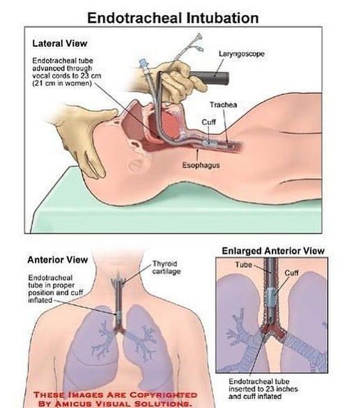 Endotrachial intubation