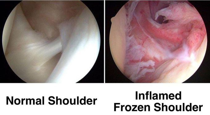 Normal Vs Inflamed Shoulder