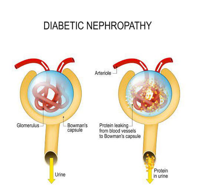 Diabetic Nephropathy