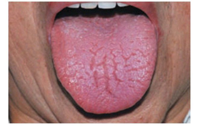 Symptoms of Sjögrens syndrome