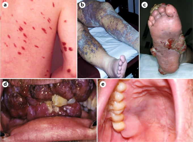 Cause of Kaposi sarcoma