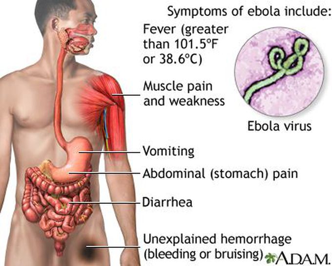 EBOLA VIRAL DISEASE