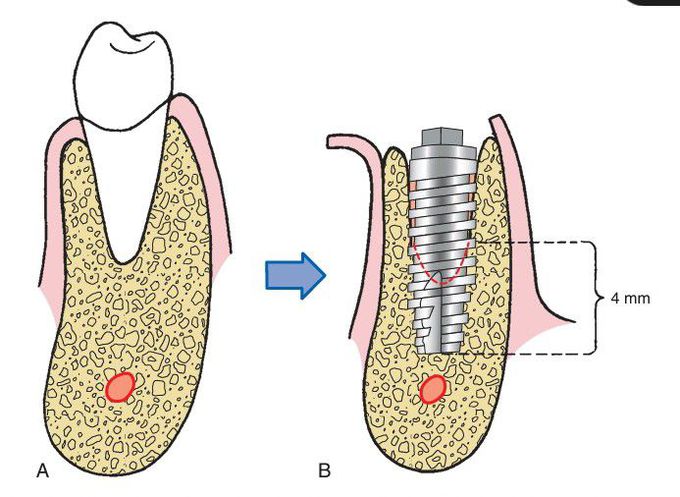 Immediate implants