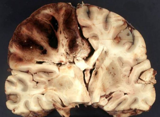 Cerebrovascular disease