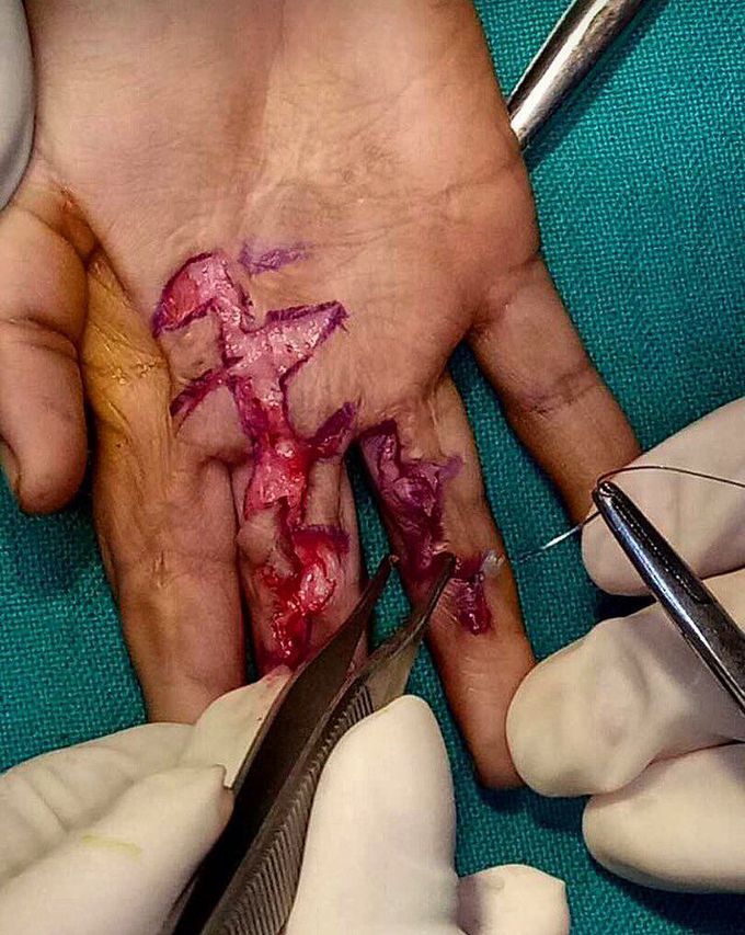 This young lady suffered a 3rd degree burn in a kitchen accident few weeks back.