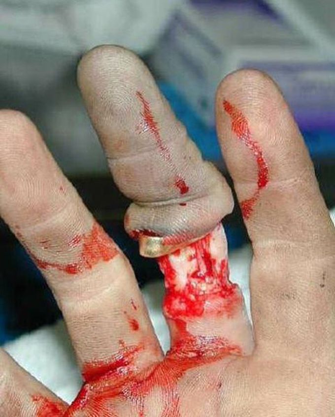 Degloving injury of the finger!