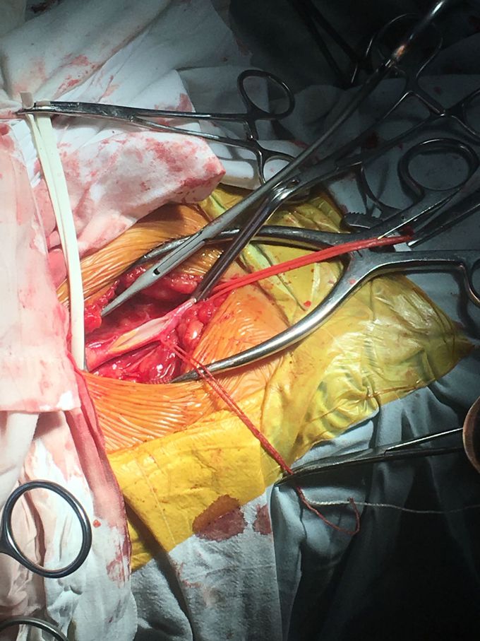 Atherosclerotic mass on a.femoralis