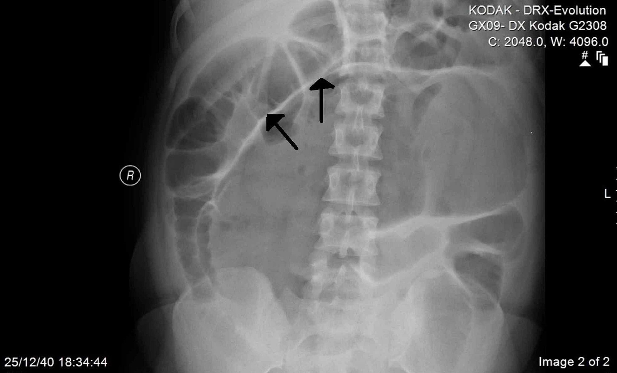 Cecal Volvulus - MEDizzy