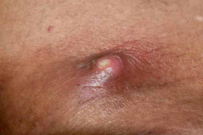 Abscess