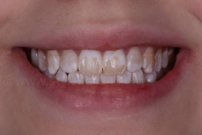 Fluorosis