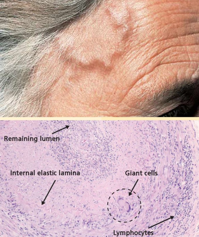 Temporal Arteritis