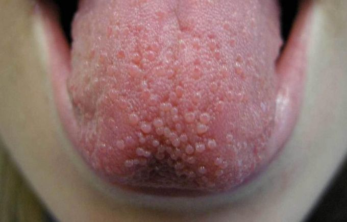 Transient lingual papillitis