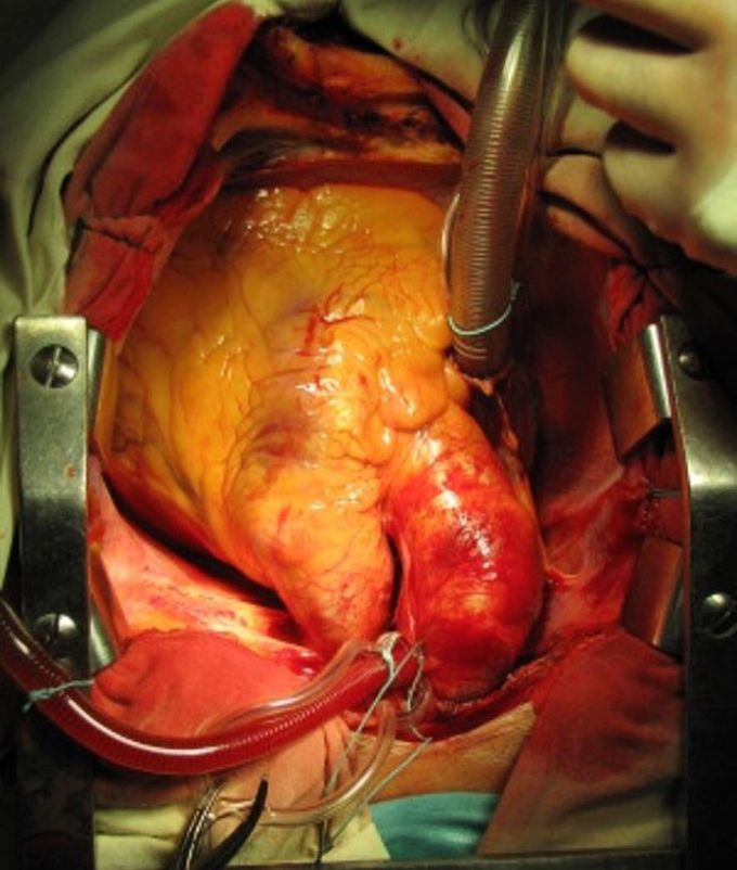 Huge aortic arch aneurysm