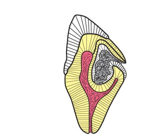 Radicular Dens Invaginatus