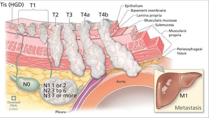 Staging of Esophageal Carcinoma